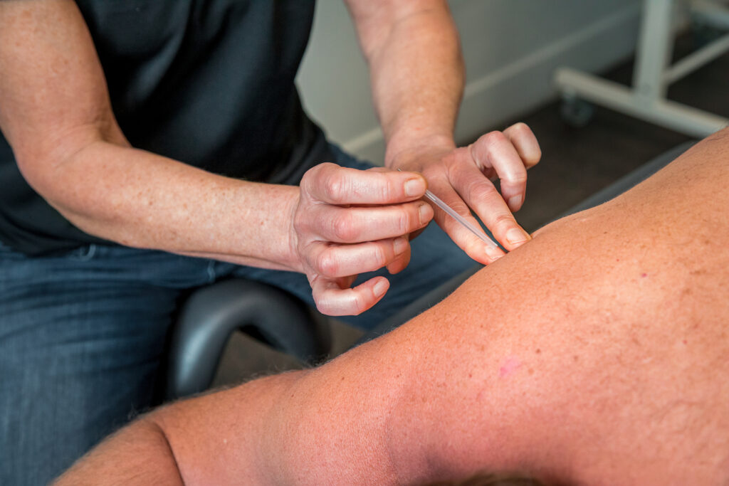 dryneedling in schouder